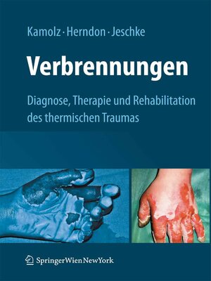 cover image of Verbrennungen